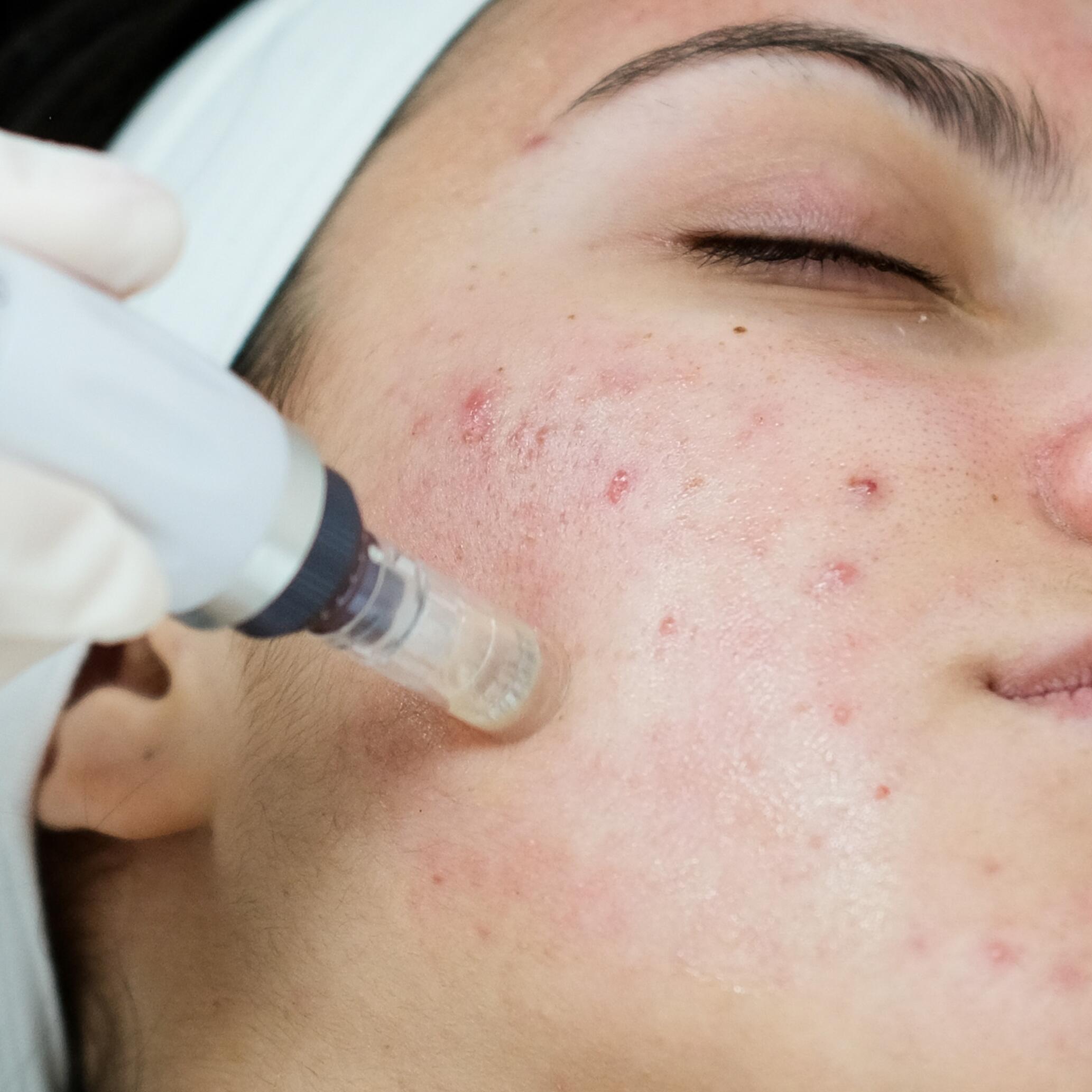 Cicatriz atrófica quirúrgica en el rostro de una mujer